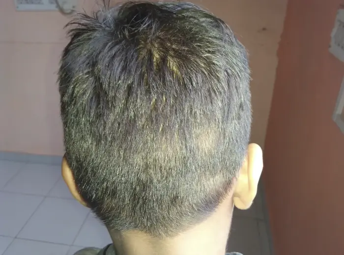 Alopecia Areata case 4 after treatment
